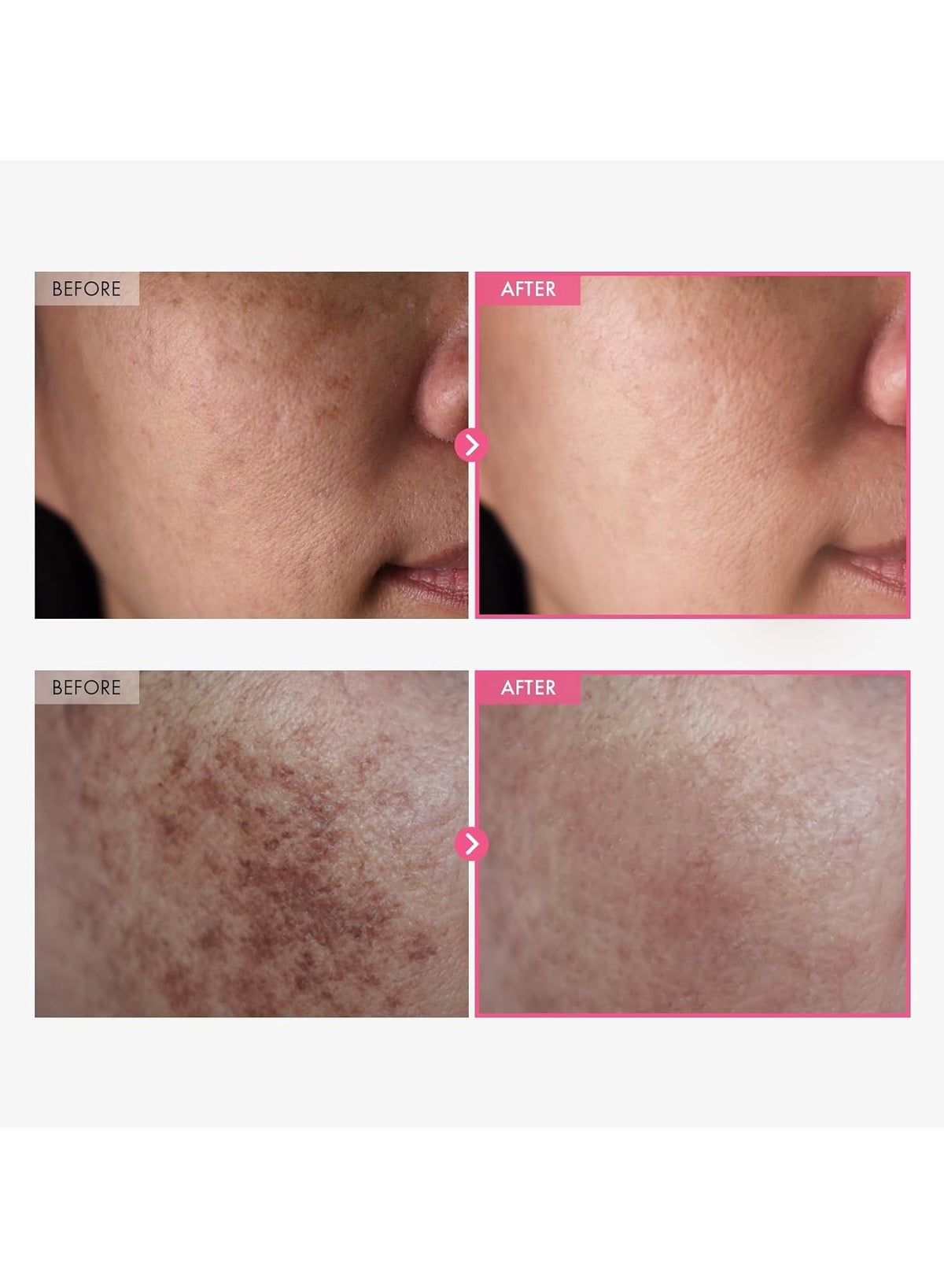 Arbutin 7% + Tranexamic Acid 4% Cream, 70,000ppm Arbutin, 40,000ppm TXA, Niacinamide, Glutathione, Dark Spots, Freckle, Blemishes, Pigmentation, Korean Skin Care, 50ml, 1.69 fl.oz. - Image 2